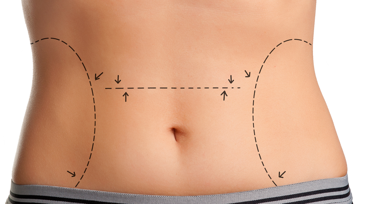 Dermolipectomia abdominal: que cirurgia é essa? - Blog Master Health