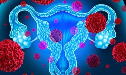 Tratamento para câncer de colo de útero: plano deve cobrir?